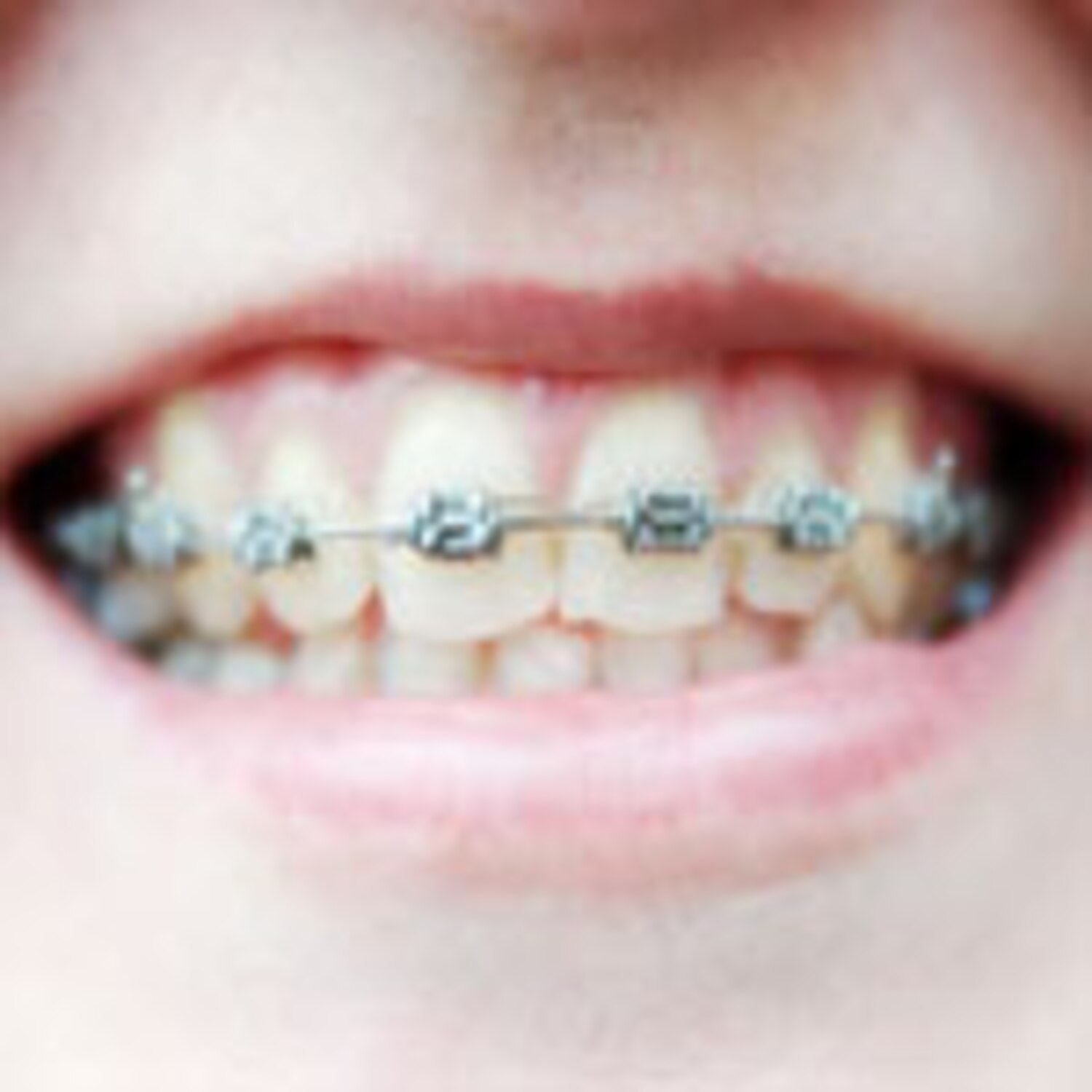 Straight teeth for less Braces and orthodontics Canadian Living
