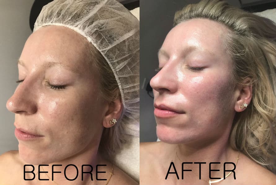 Microneedling With Prp