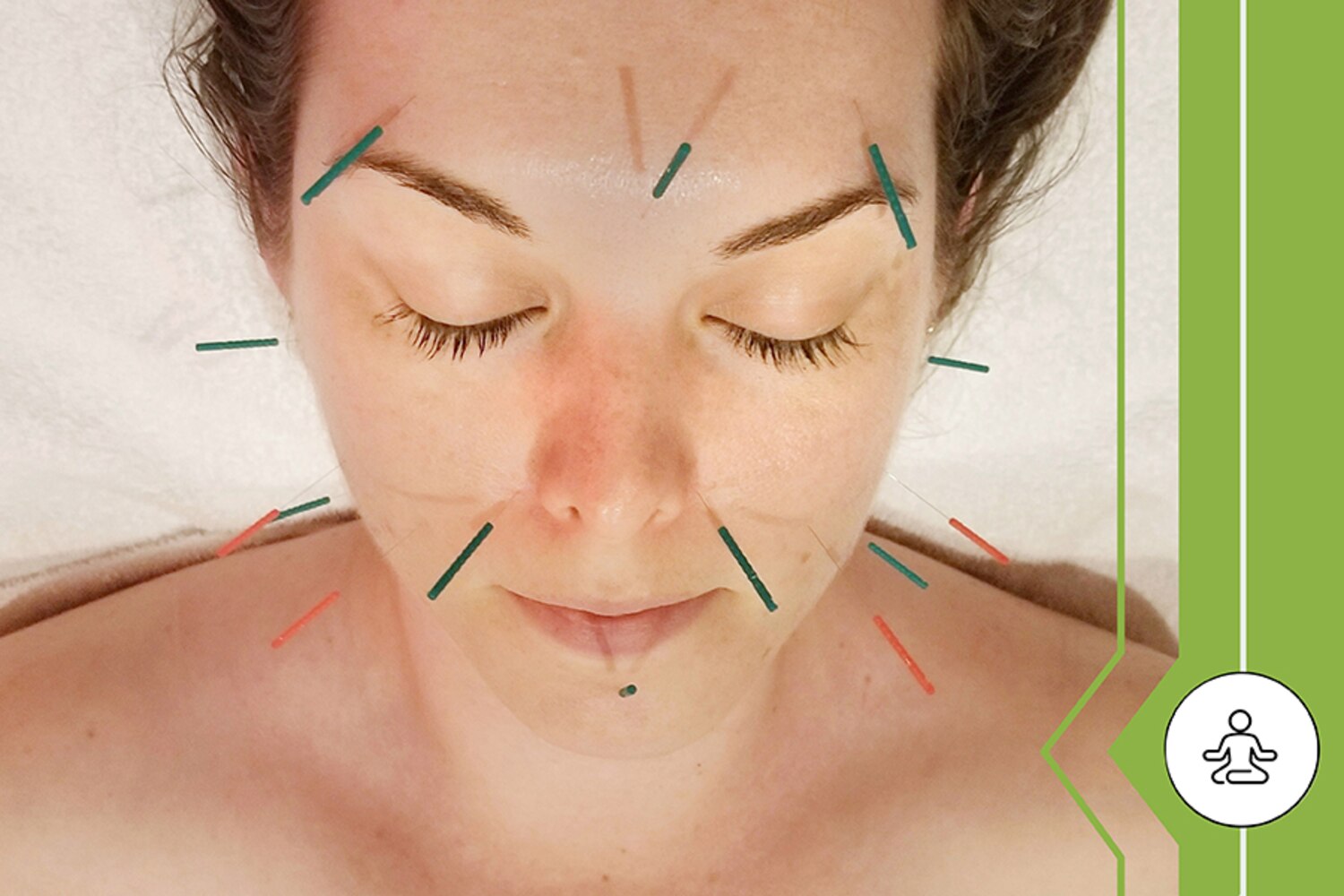 We tried it Facial Acupuncture at Province Apothecary Canadian Living
