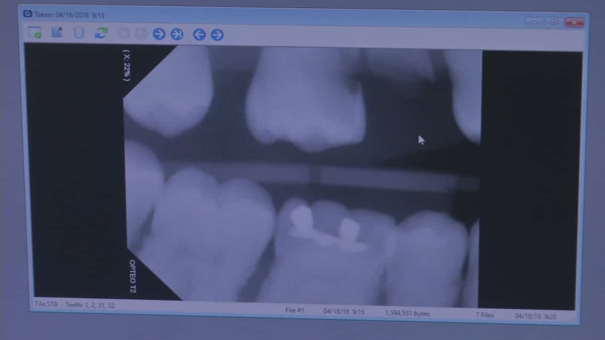 Le régime de soins dentaires fédéral est très populaire au Québec