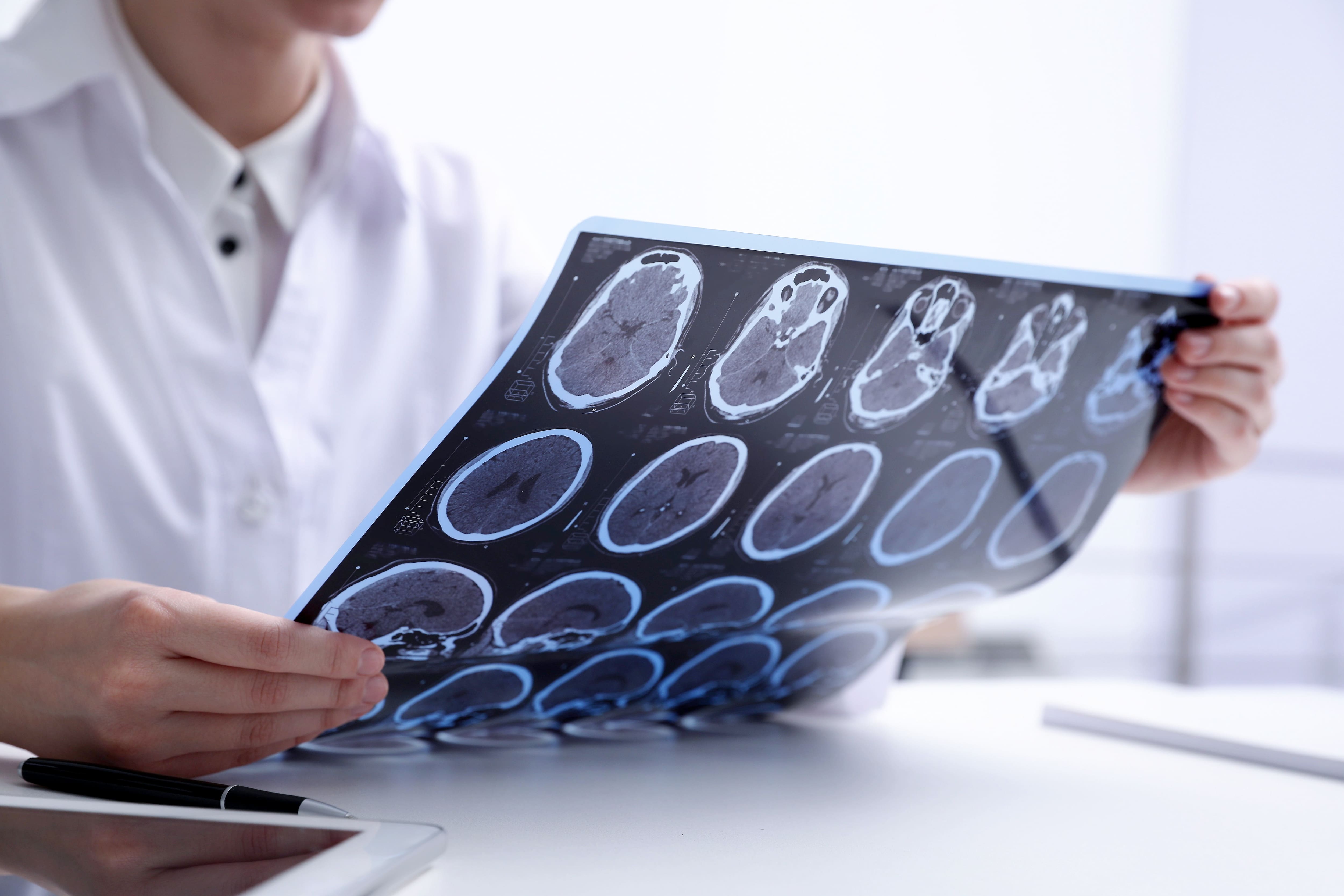 «Ça laisse des traces sur le cerveau»: les commotions cérébrales sont à prendre au sérieux