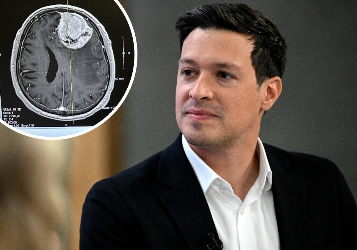 Qu'est-ce que le méningiome, la tumeur affectant le cerveau dont souffre le maire de Laval?