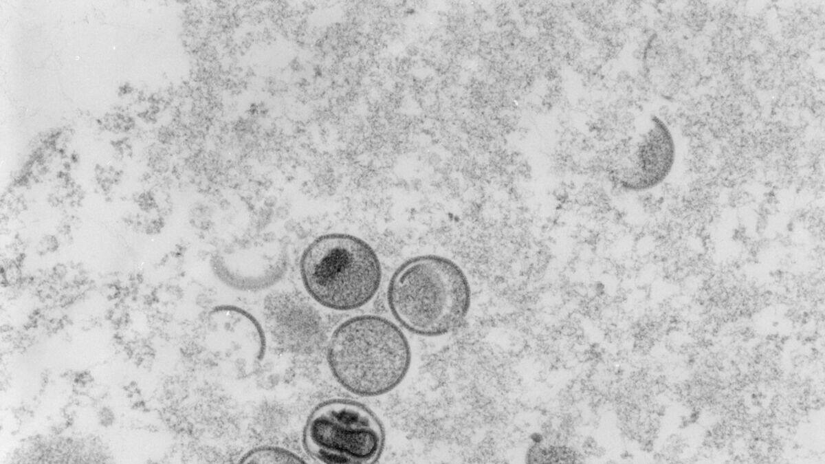 Premier cas de variole du singe détecté au Japon