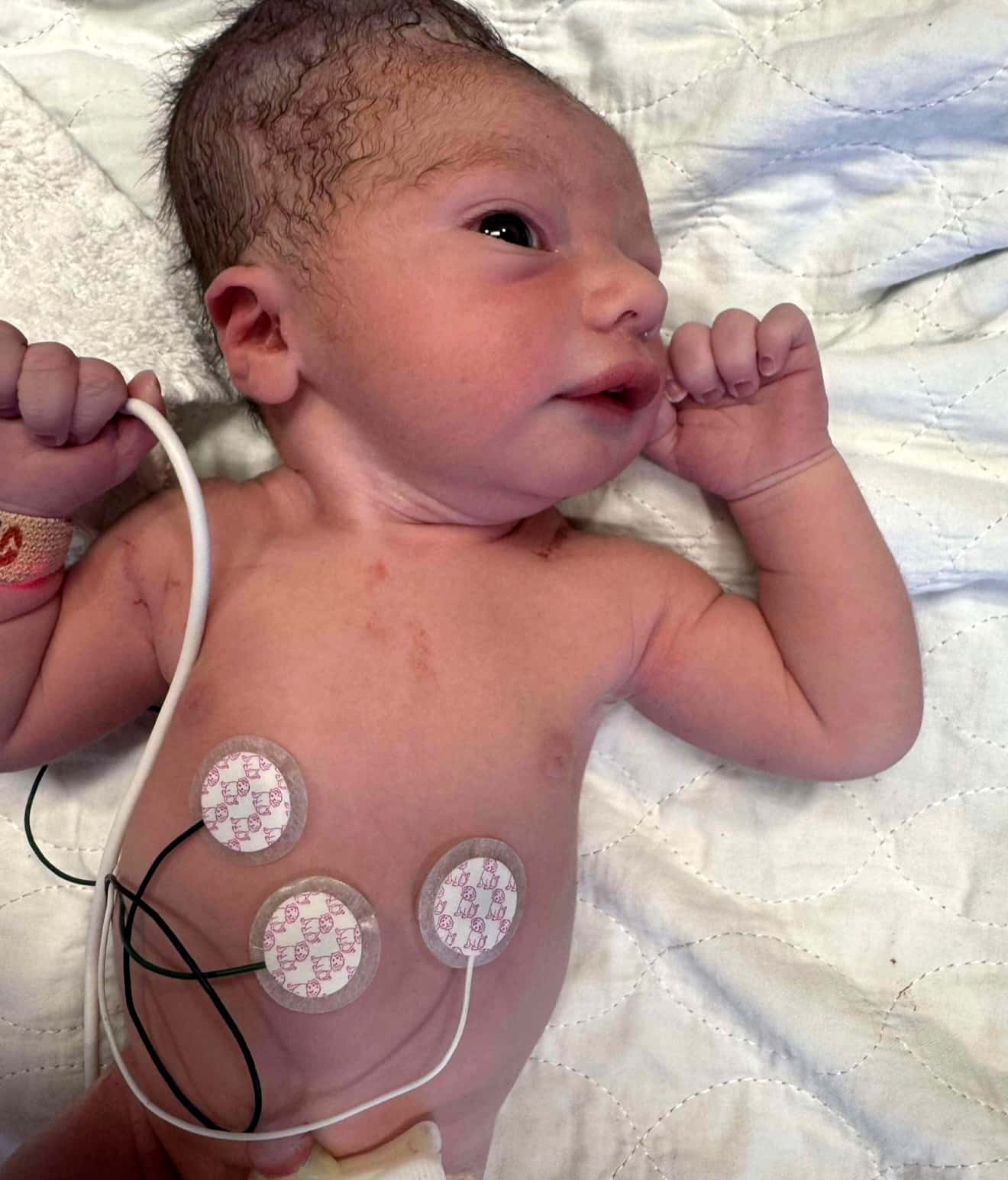 La tête de James à la naissance, après avoir passé environ deux heures dans le bassin maternel.