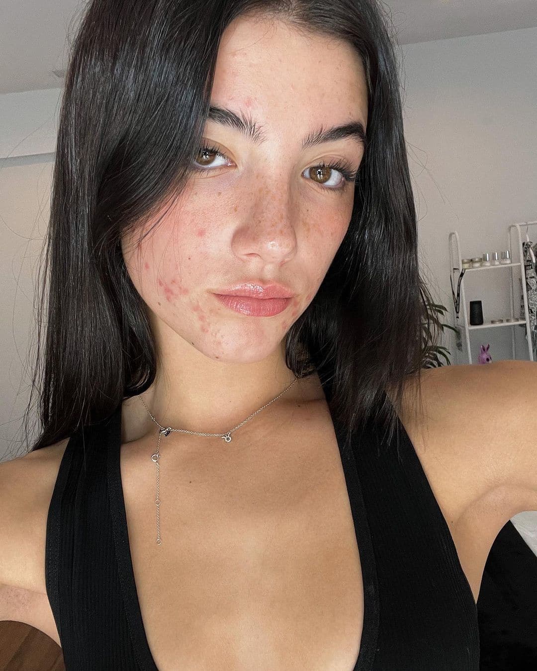 Charli D’Amelio refuse de cacher son acné