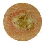 Les types de grains de beauté et comment identifier ceux qui pourraient — free download