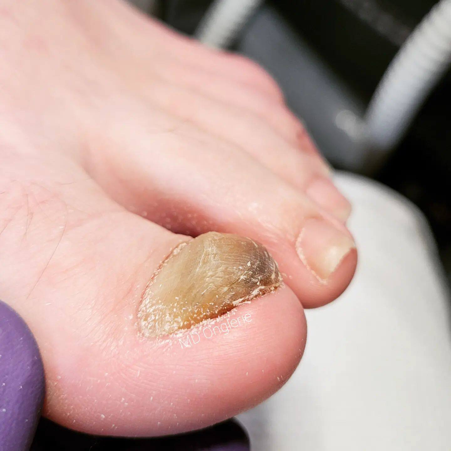 infection fongique des doigts