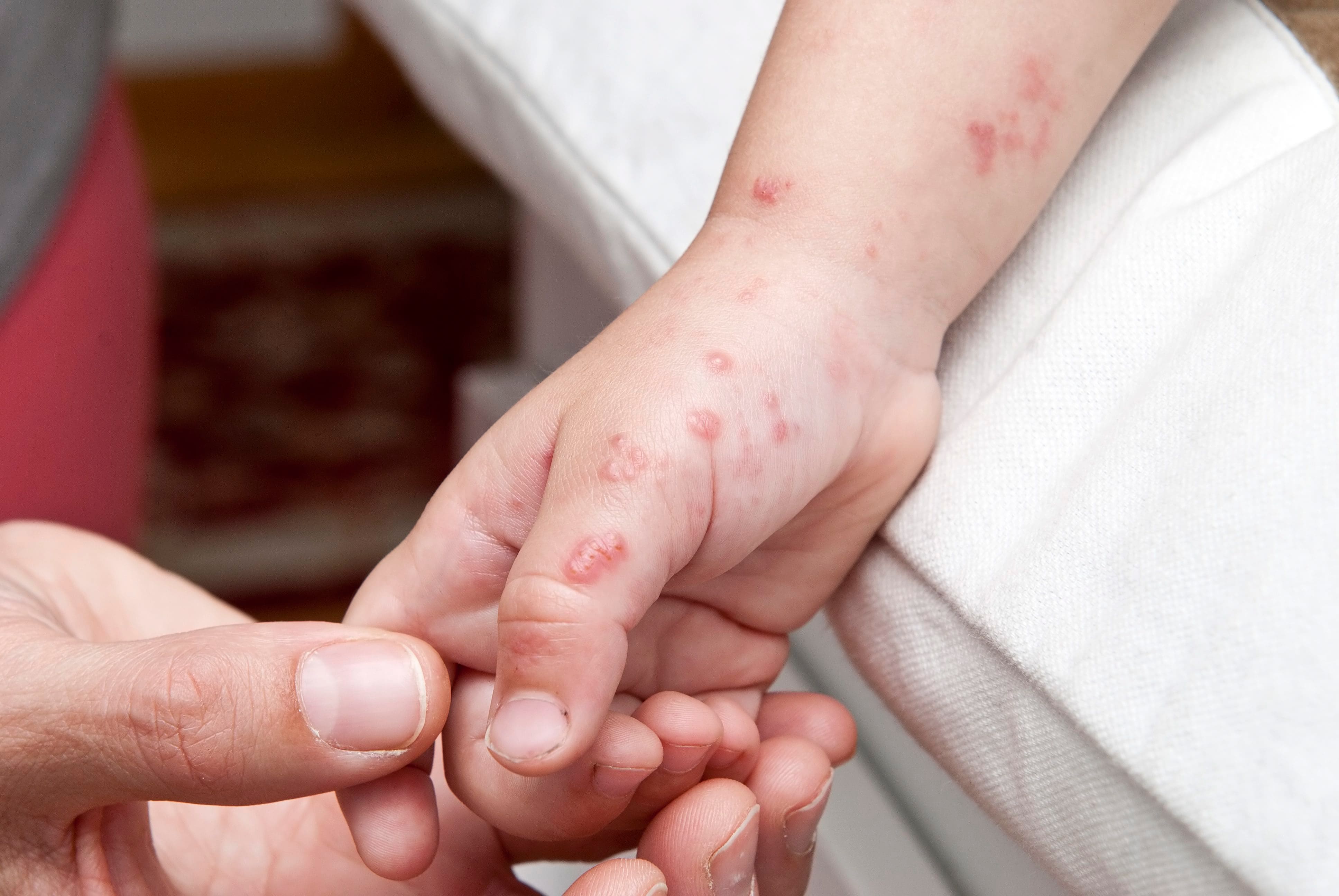 « Les gens prennent un coup de vieux après le zona » :  Des médecins plaident pour une plus grande vaccination