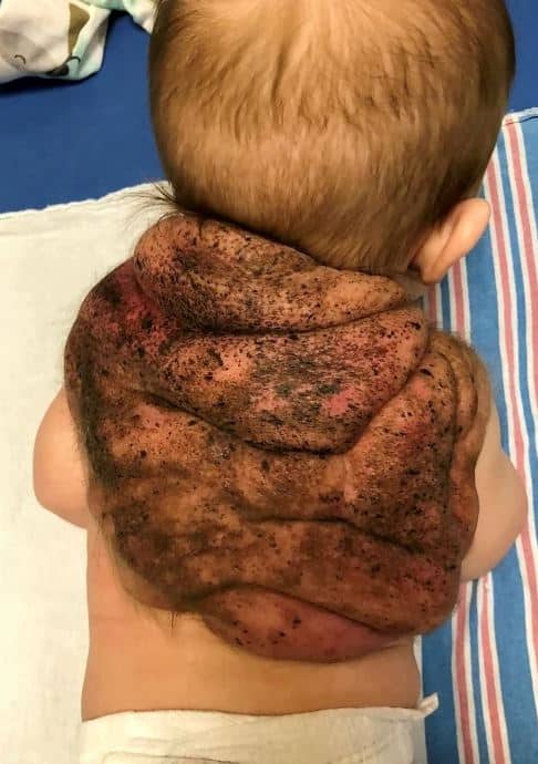 ‘Ninja Turtle’: Their baby grows a ‘shell’ on its back