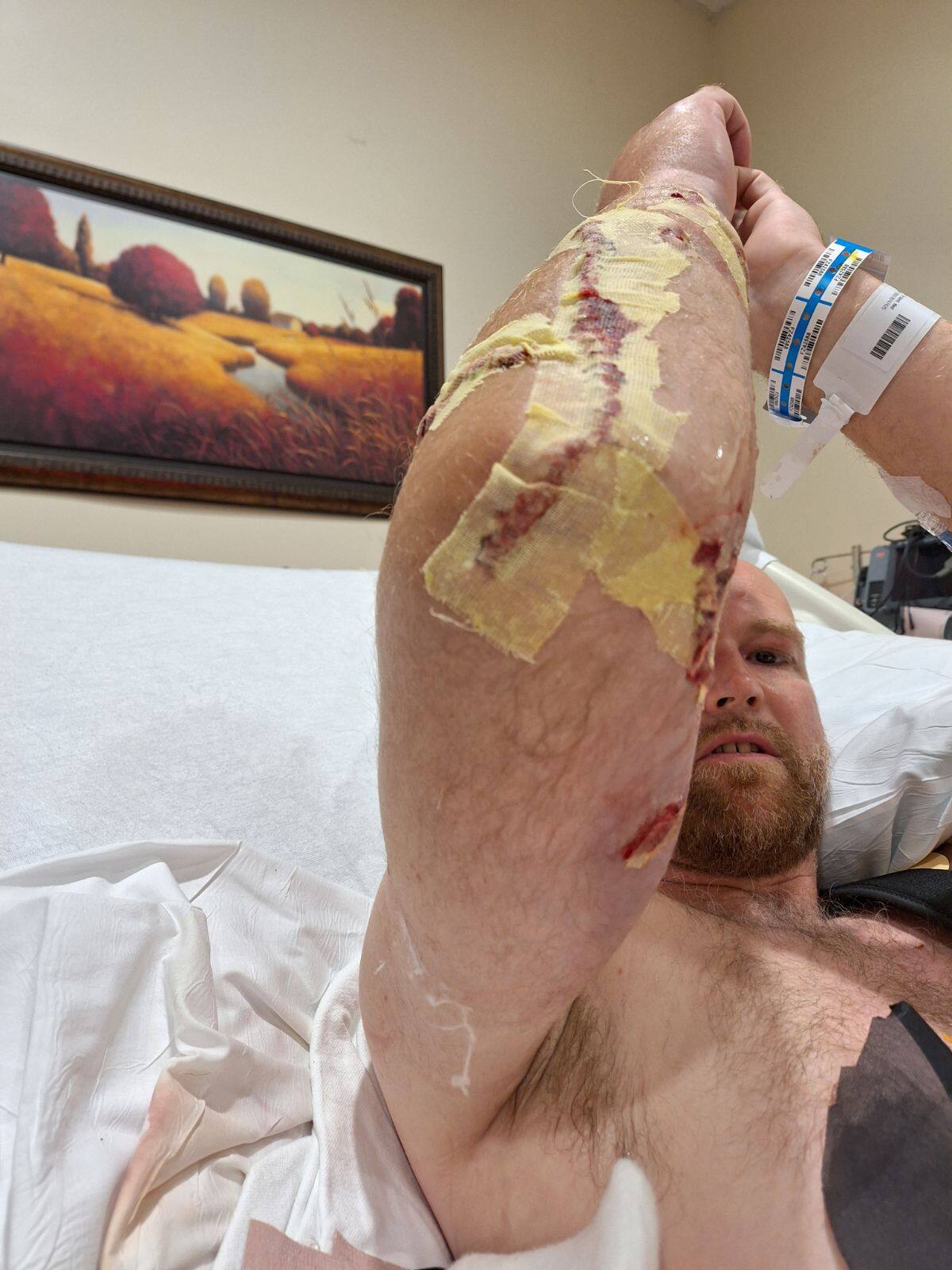 Attaqu&eacute; par un alligator, il passe proche de perdre son bras