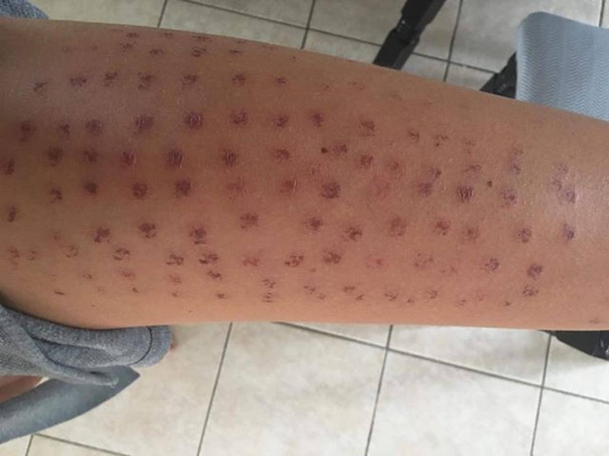 [PHOTOS] Une épilation au laser qui tourne au cauchemar JDM