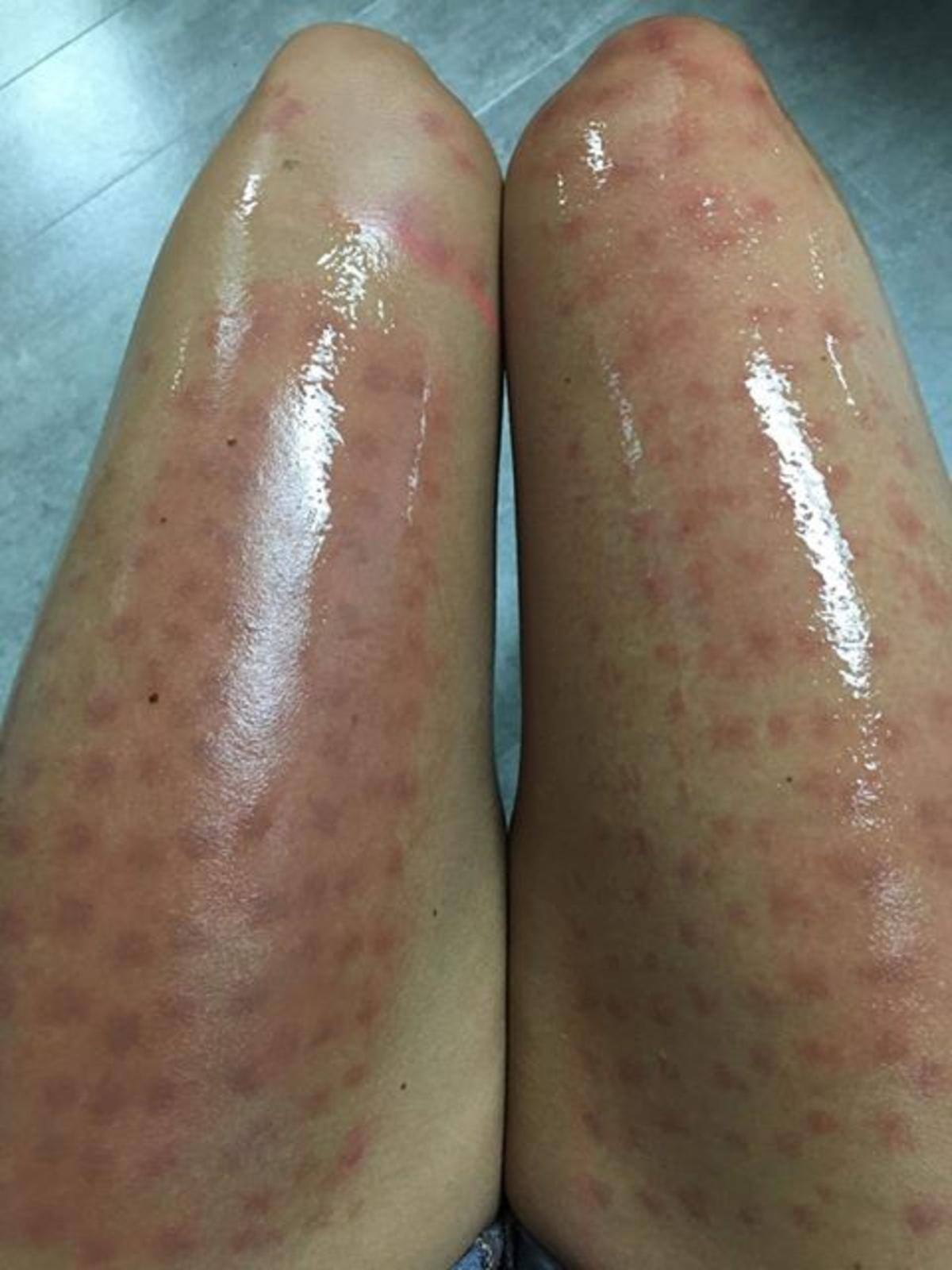 Anne-Marie Thibeault a &eacute;t&eacute; gravement br&ucirc;l&eacute;e aux jambes lors d'une proc&eacute;dure d'&eacute;pilation au laser qui a vir&eacute; au cauchemar.