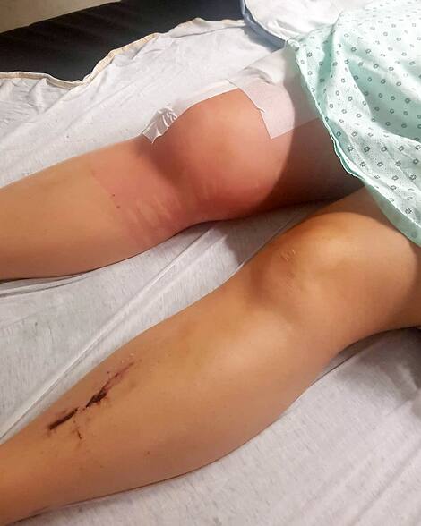 australian quebec Her right knee is very swollen here.