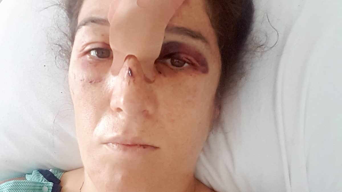 Stuck here after a hard face-to-face with a tree 1