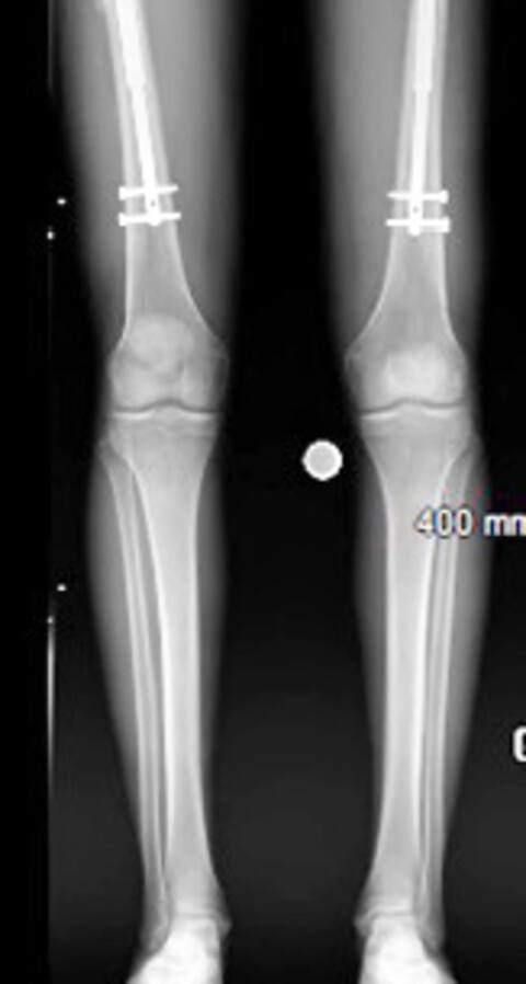 A steel nail is inserted into the femur or tibia (femur in the photo), and the extension is done in the following months. The patient had a further 8 cm at the level of the femur, and 7 cm at the tibia.