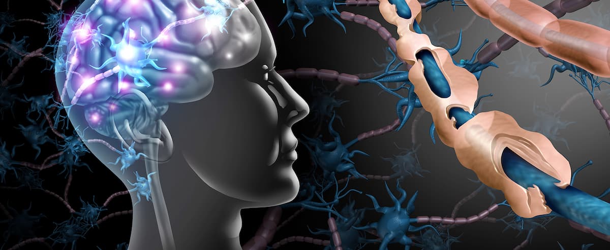 La sclérose en plaques, une maladie d’origine virale