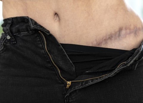 This 40-year-old believed she died last September, weeks after contracting an infection after plastic surgery. This is one of the scars after surgery.