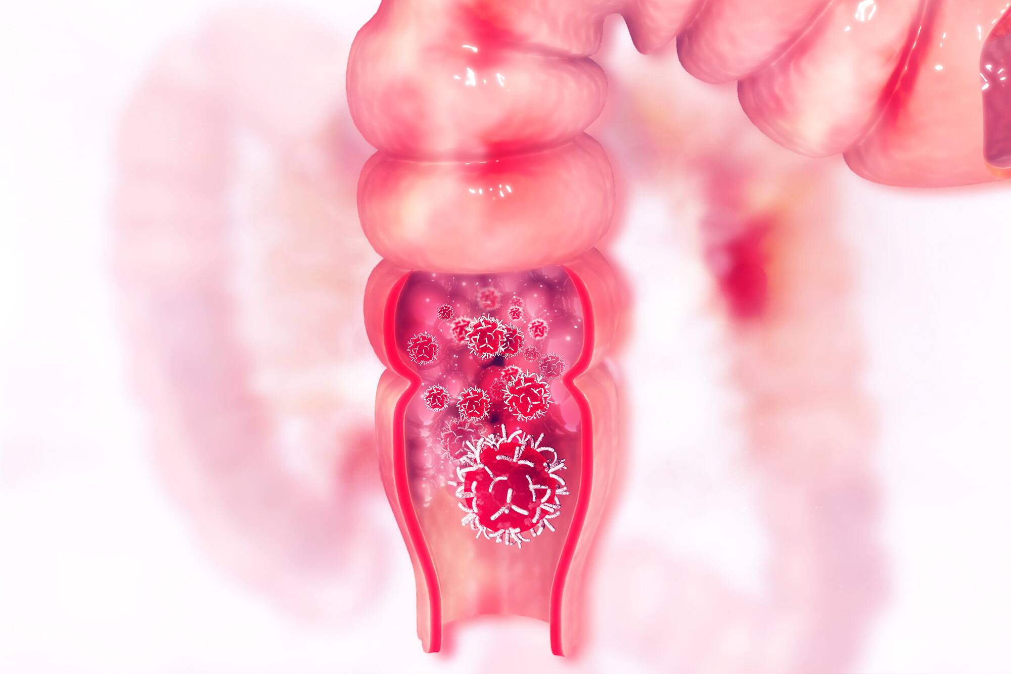 Des gu&eacute;risons du cancer vraiment spectaculaires