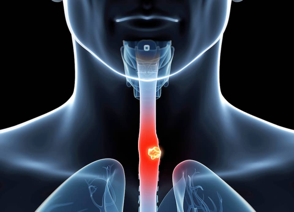 La progression fulgurante du cancer de l’œsophage JDM La progression fulgurante du cancer de l’œsophage JDM