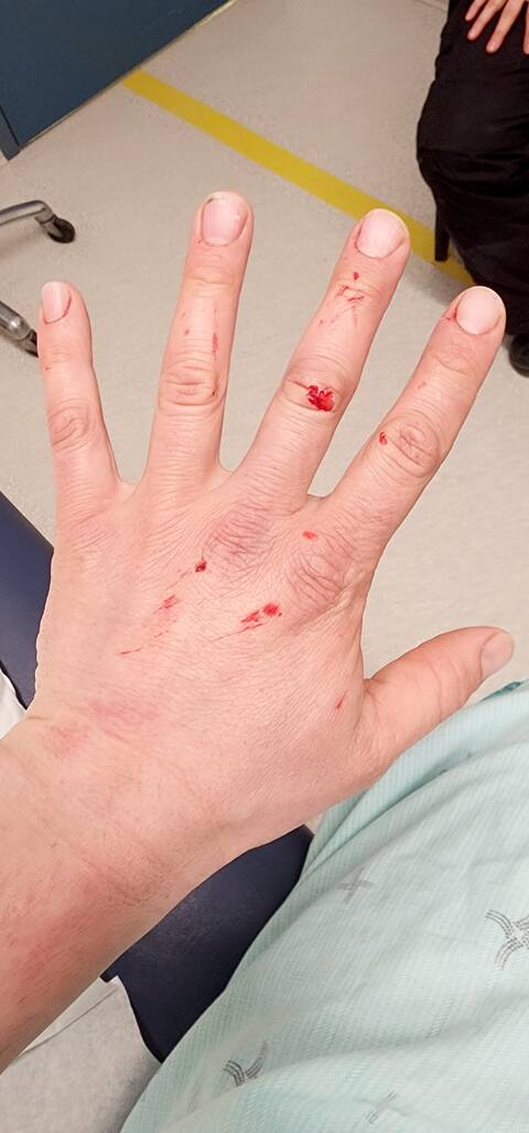 Scars on Bruno Astiguin's arm after an avalanche.