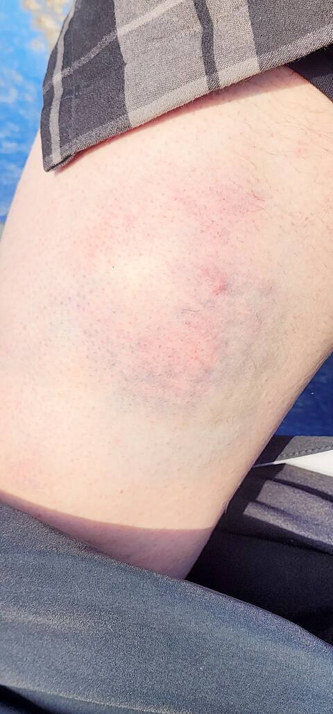 One of the injuries on the skier's body after an avalanche.