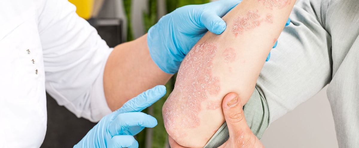 Les conseils d'une dermatologue pour vivre avec le psoriasis