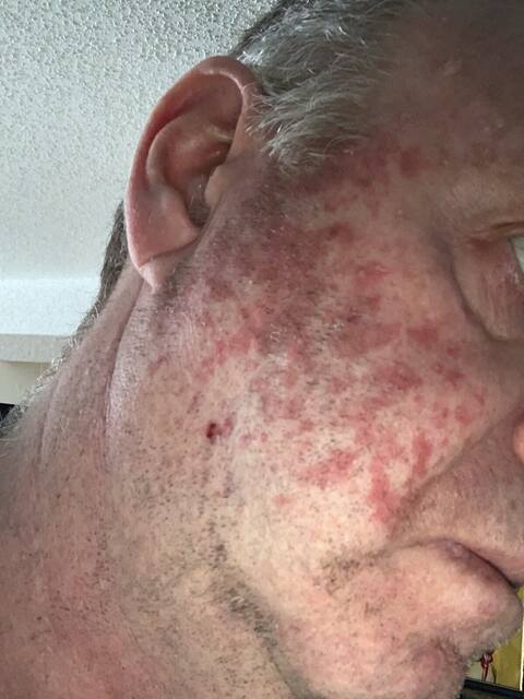 Dany Tremblay admits to having abused tanning salons for more than 25 years, in his youth. As a result, the actor sees painless masses appear on his body, especially the face, which he then has to have removed.