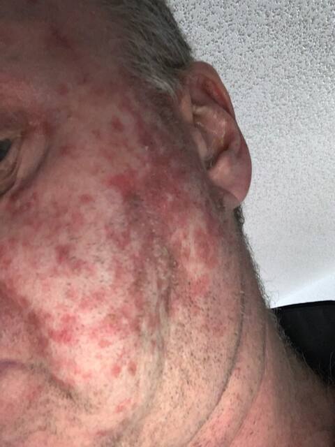 Dany Tremblay admits to having abused tanning salons for more than 25 years, in his youth. As a result, the actor sees painless masses appear on his body, especially the face, which he then has to have removed.