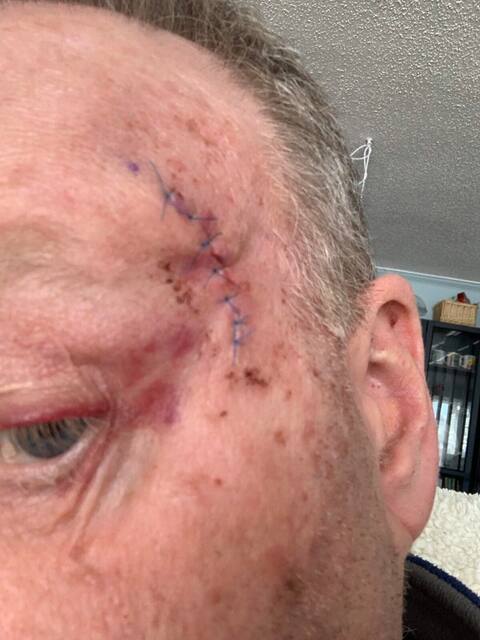 Dany Tremblay admits to having abused tanning salons for more than 25 years, in his youth. As a result, the actor sees painless masses appear on his body, especially the face, which he then has to have removed.