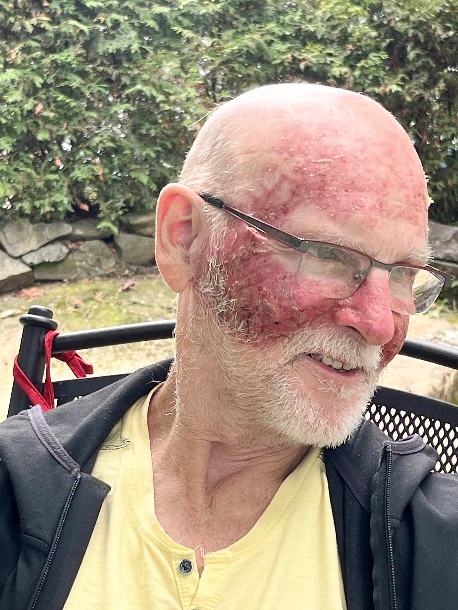 «Je ne mettais pas de crème solaire»: il publie des photos de son précancer de la peau pour mettre en garde le public