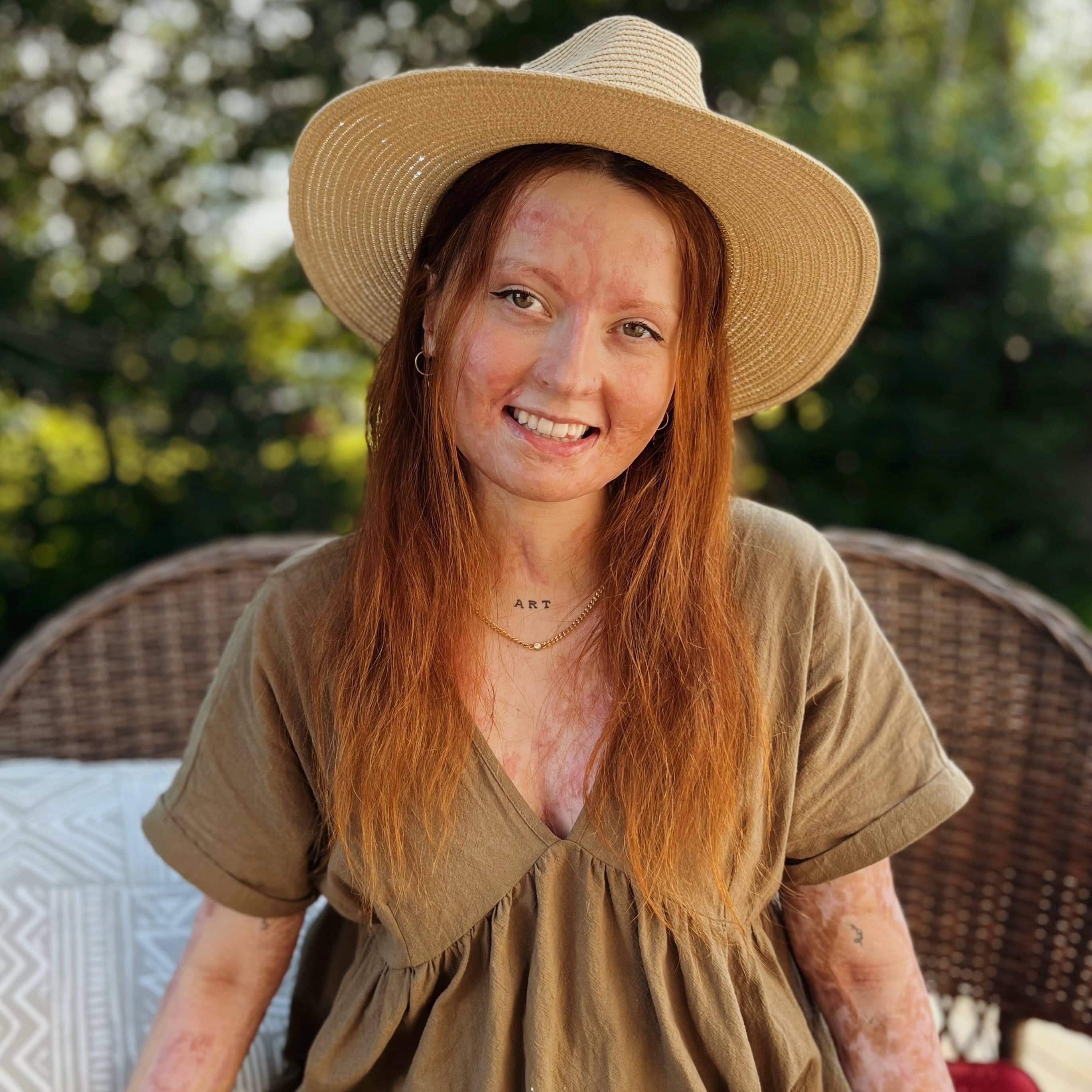 «C’est l’acte le plus généreux et altruiste»: une Québécoise brûlée sur 80% de son corps incite les gens à signer leur carte