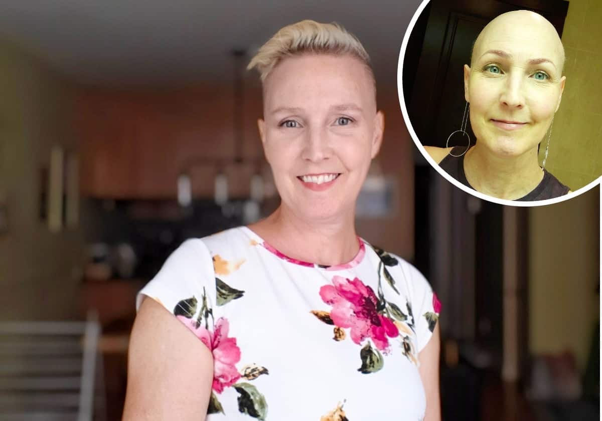 «Tout le monde pensait que j’avais le cancer»: sa maladie lui a fait perdre tous ses cheveux et aucun traitement n’est remboursé