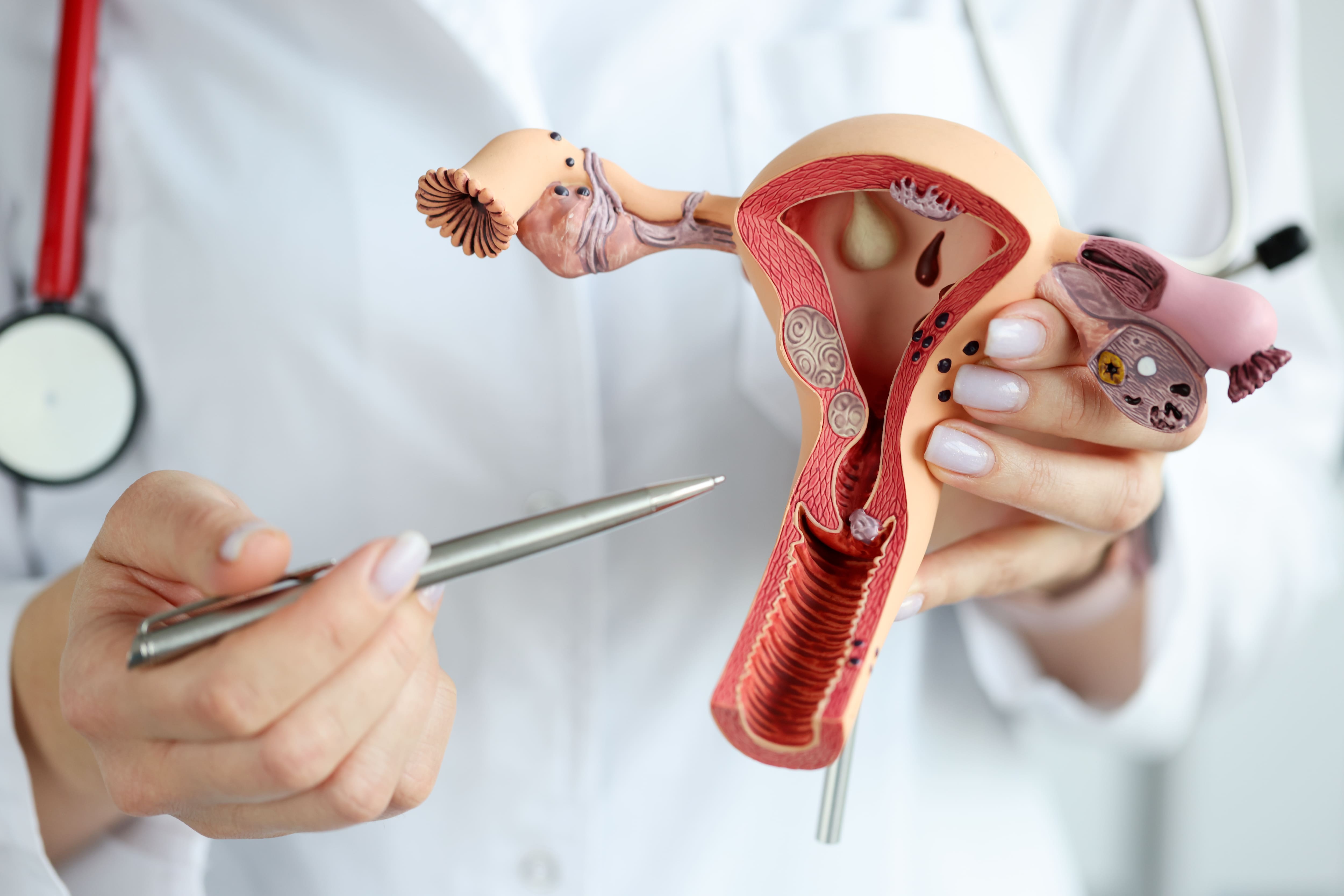 Maladie féminine méconnue: le syndrome des ovaires polykystiques change de nom