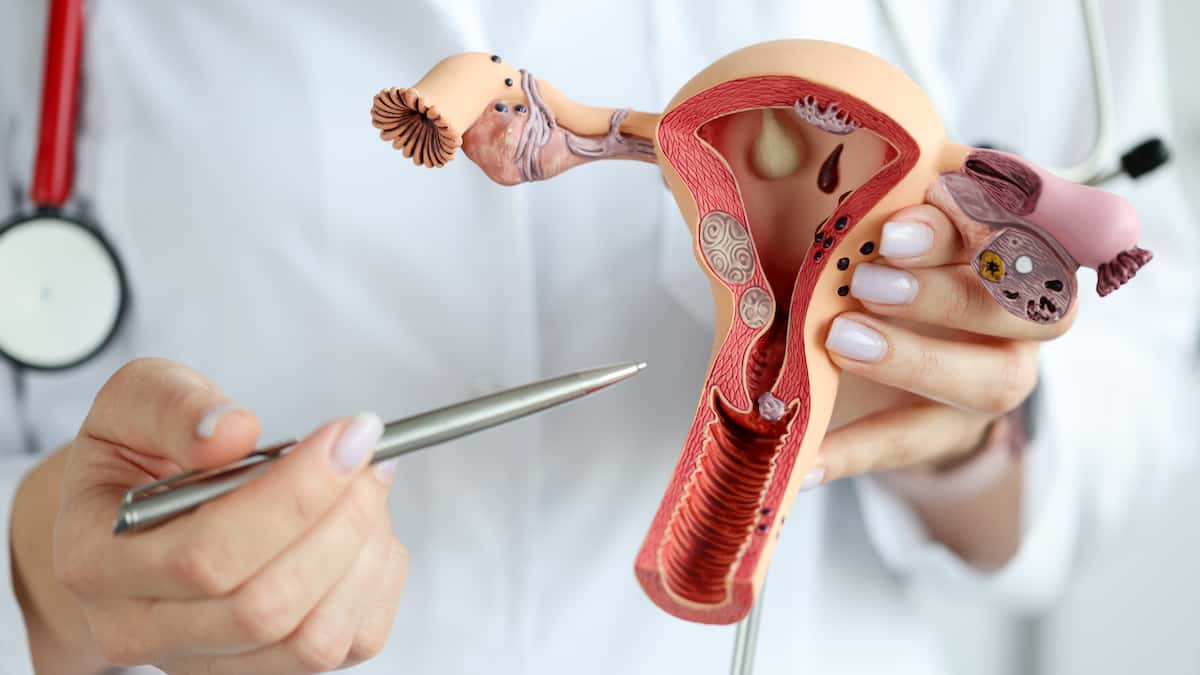 Maladie féminine méconnue: le syndrome des ovaires polykystiques change de nom