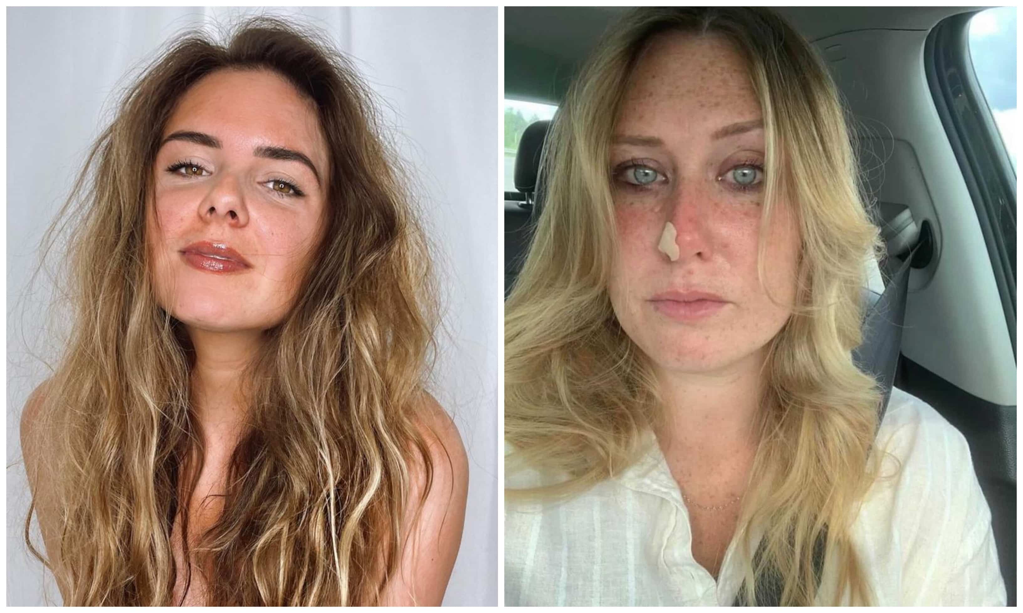 Un témoignage percutant sur le cancer de la peau