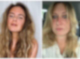 Un témoignage percutant sur le cancer de la peau