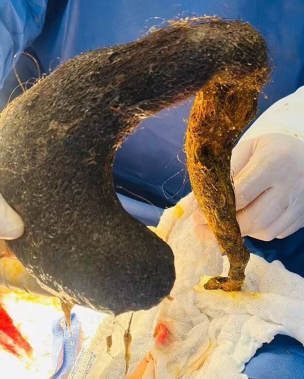 Une boule de cheveux de 2 lb trouv&eacute;e dans l&rsquo;estomac d&rsquo;une femme