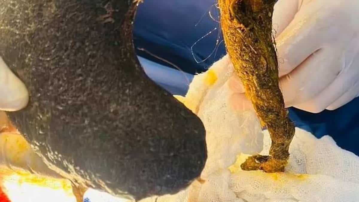 Une boule de cheveux de 2 lb trouvée dans l’estomac d’une femme