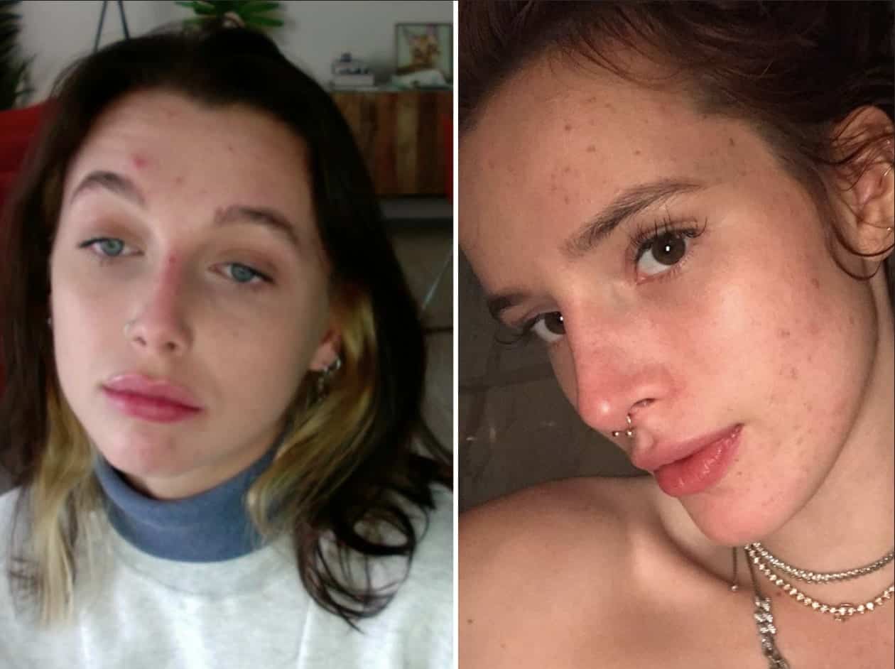Ces célébrités affichent leur acné