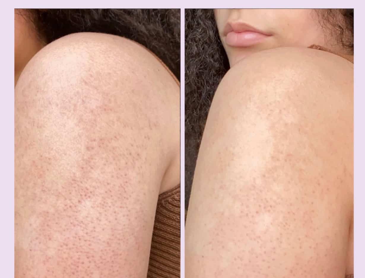 Kératose pilaire: traitements et solutions