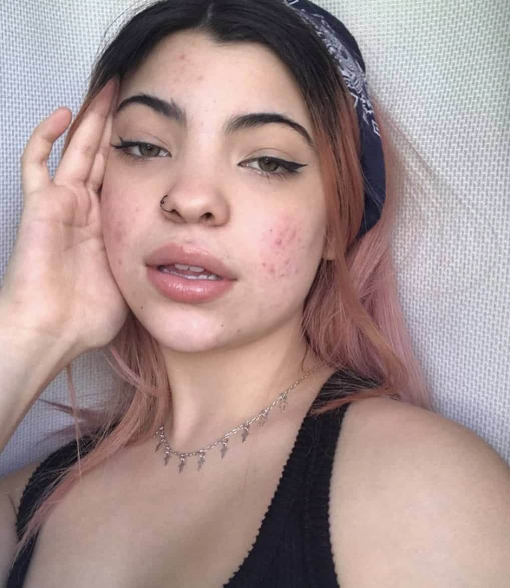 L'ingrédient #1 pour lutter contre l'acné 