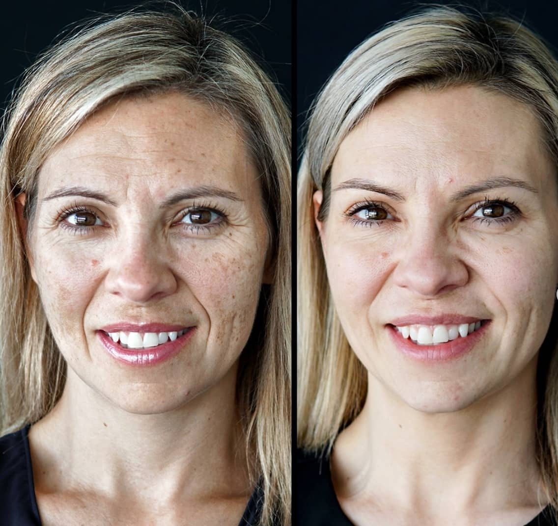 J’ai testé le traitement IPL contre la rosacée