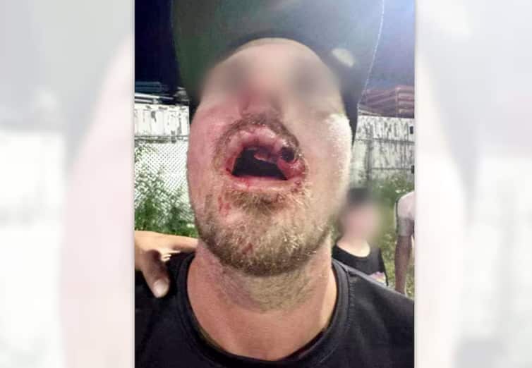 Photo des blessures causées à un arbitre de Dek Hockey Beauport par Kevin Bilodeau lors d'un match en juillet 2024. Bilodeau a plaidé coupable à des accusations de voies de fait armées et causant des lésions, ainsi que de menaces.