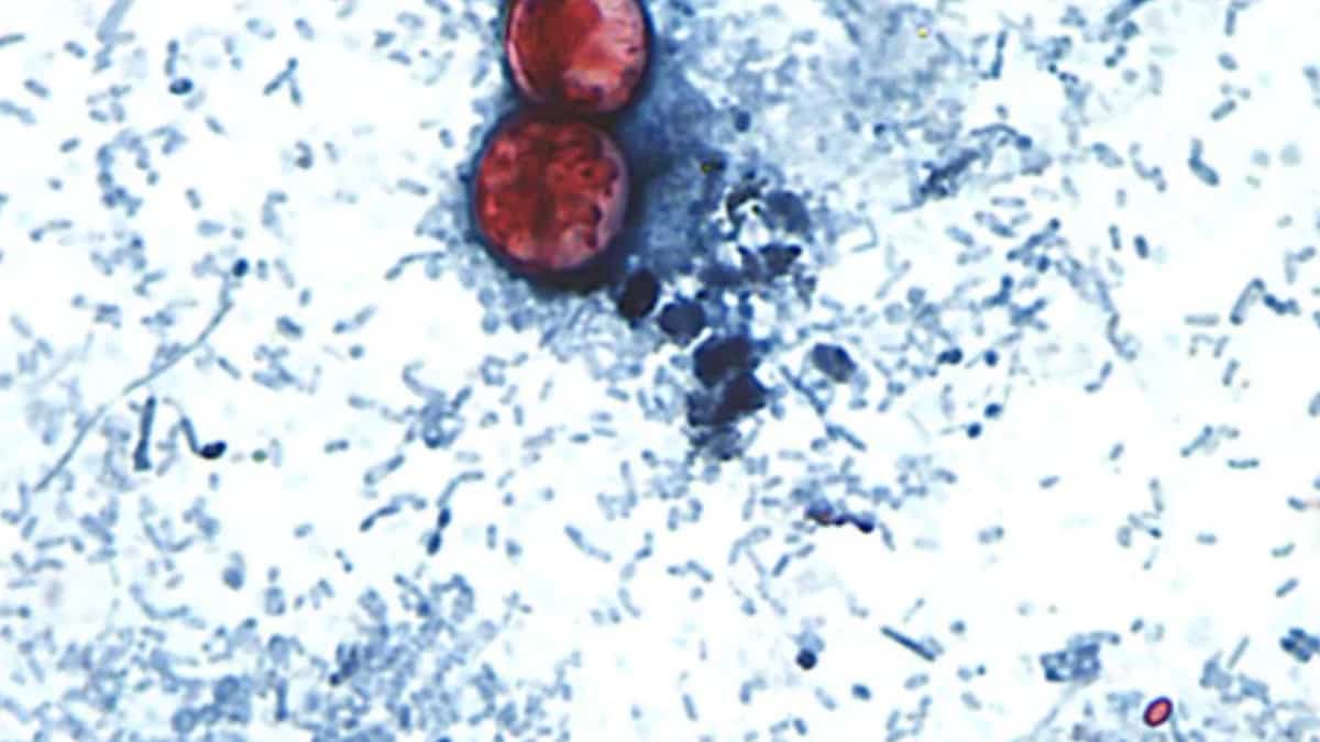 Cyclosporosis epidemic in the United States: here is the status of the situation so far Cyclosporosis epidemic in the United States: here is the status of the situation so far