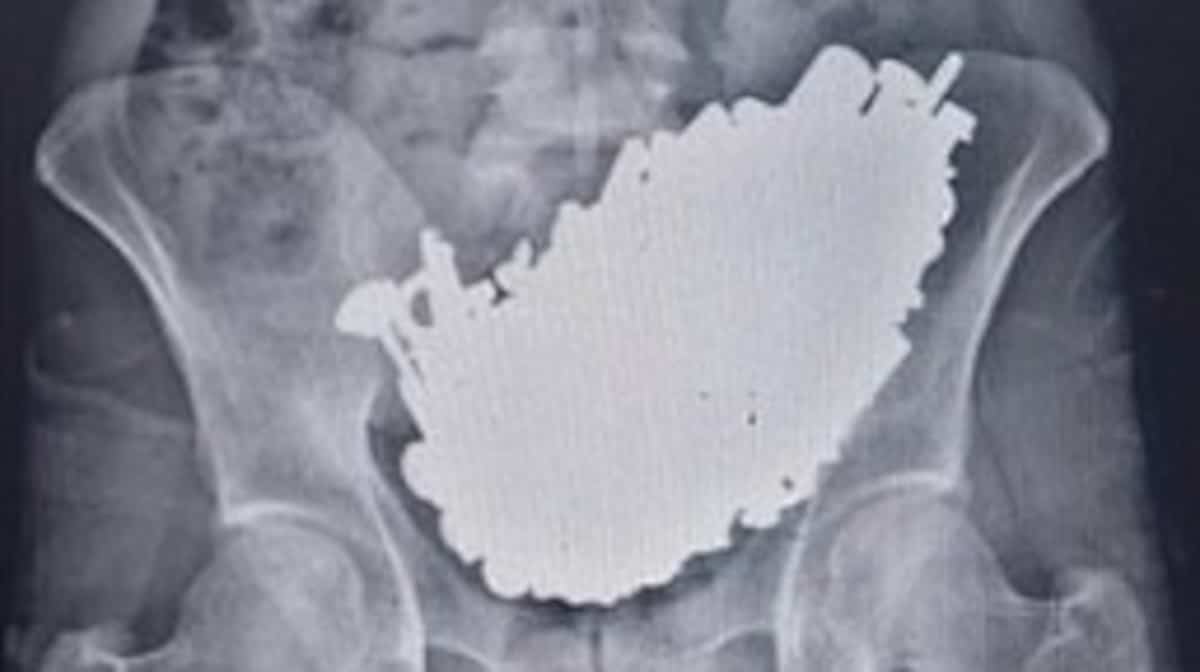 “3 kilos of scrap”: Doctors remove 452 pieces of metal from his stomach “3 kilos of scrap”: Doctors remove 452 pieces of metal from his stomach