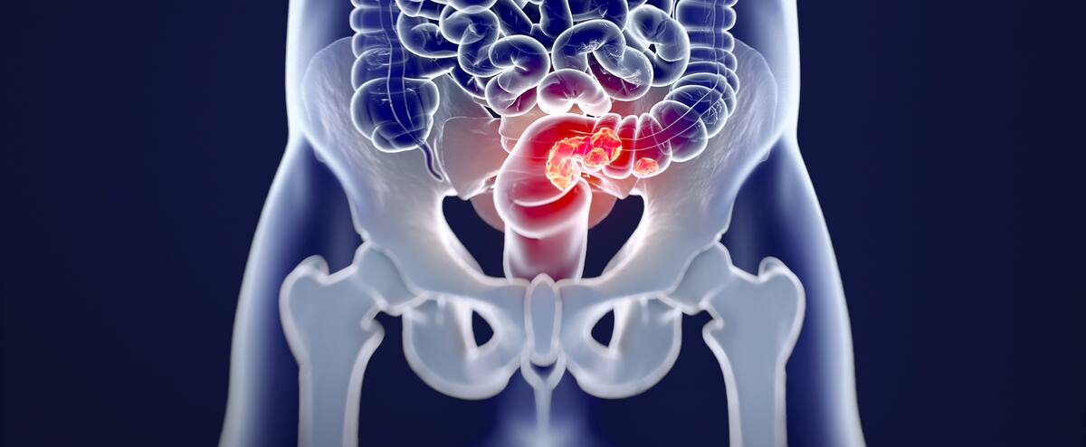 Obésité maternelle: un facteur de risque de cancer colorectal précoce chez l’enfant