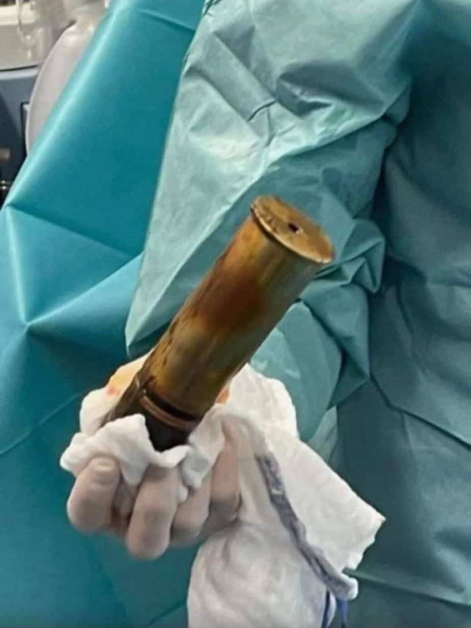 Image principale de l'article Il va à l’urgence avec un obus pris dans l’anus