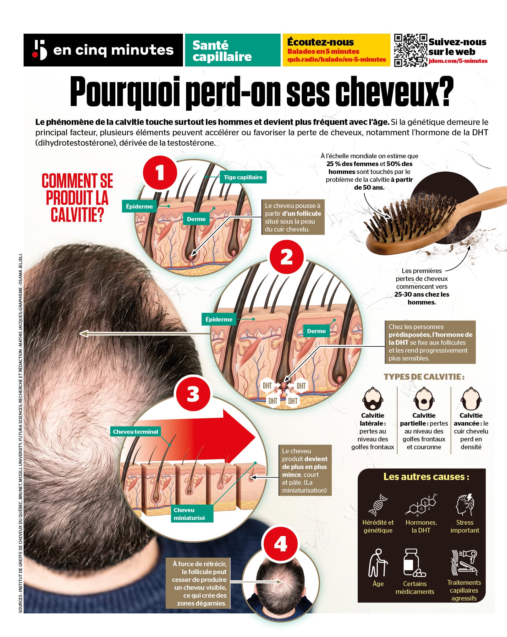 INFOGRAPHIE | La calvitie expliquée