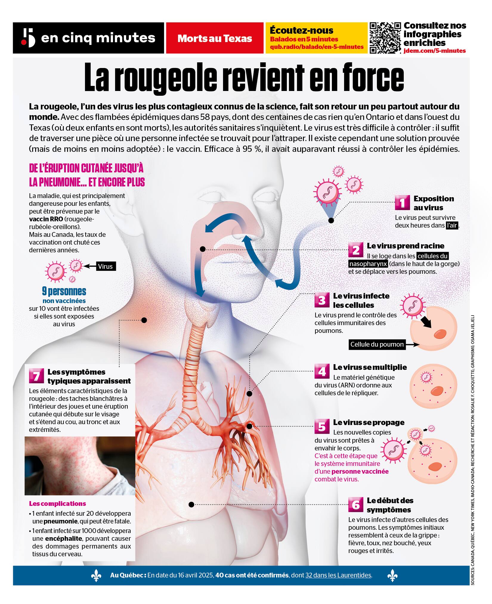 Retour en force de la rougeole: comment le virus attaque | JDM