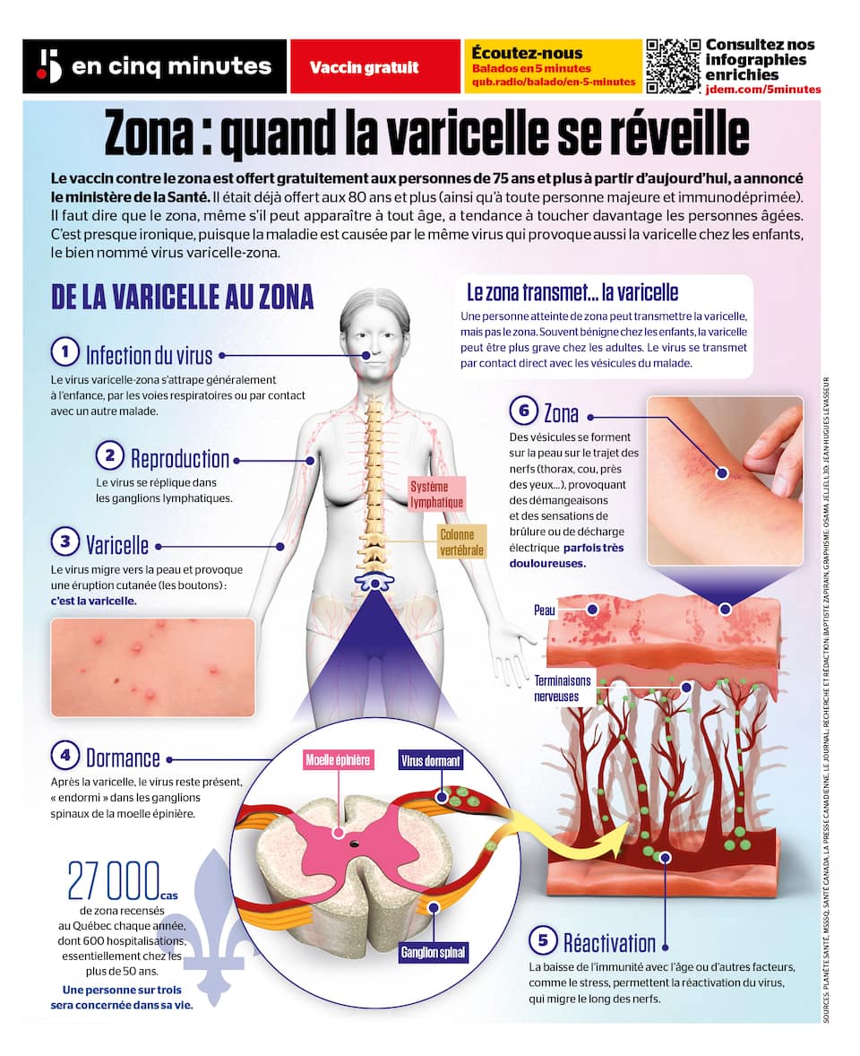 Zona La Varicelle Qui Se R veille Le Journal De Qu bec zona-la-varicelle-qui-se-r-veille-le-journal-de-qu-bec